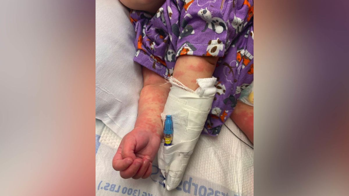 VDH reports cases of COVID ‘multisystem inflammatory syndrome’ in children